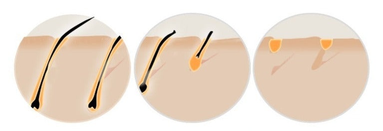 At-Home IPL Laser Hair Removal Device