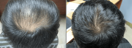 Anti Hair Loss Growth Serum