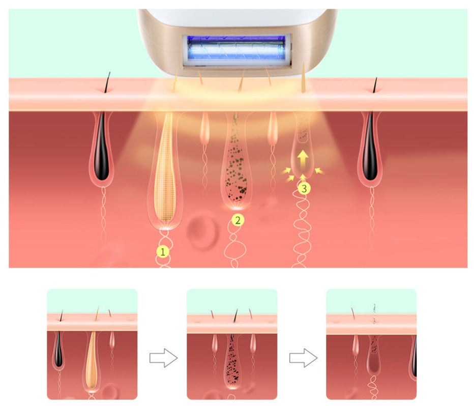 IPL Laser Hair Removal Device
