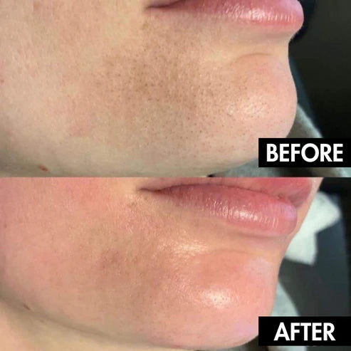 Electric Blackhead Remover Vacuum – Pore Cleaner & Acne Extractor Tool