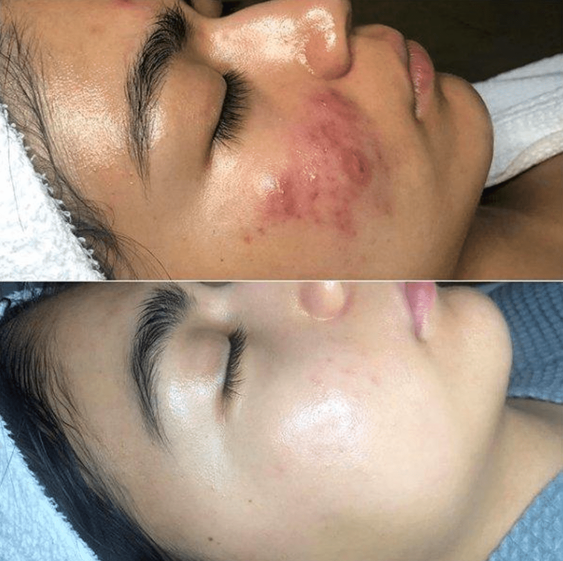High Frequency Skin Therapy