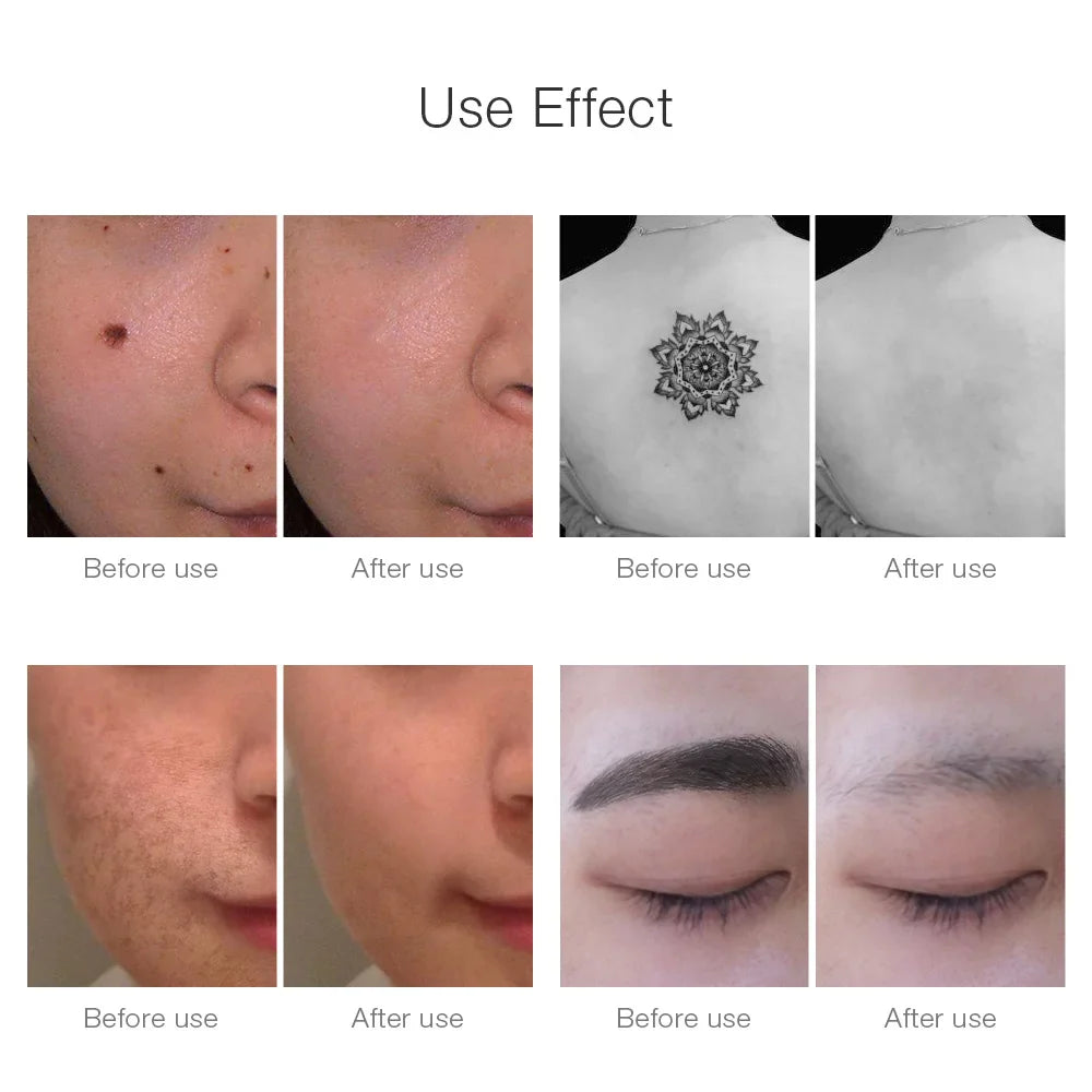 Picosecond Laser Remover For Tattoos & Spots