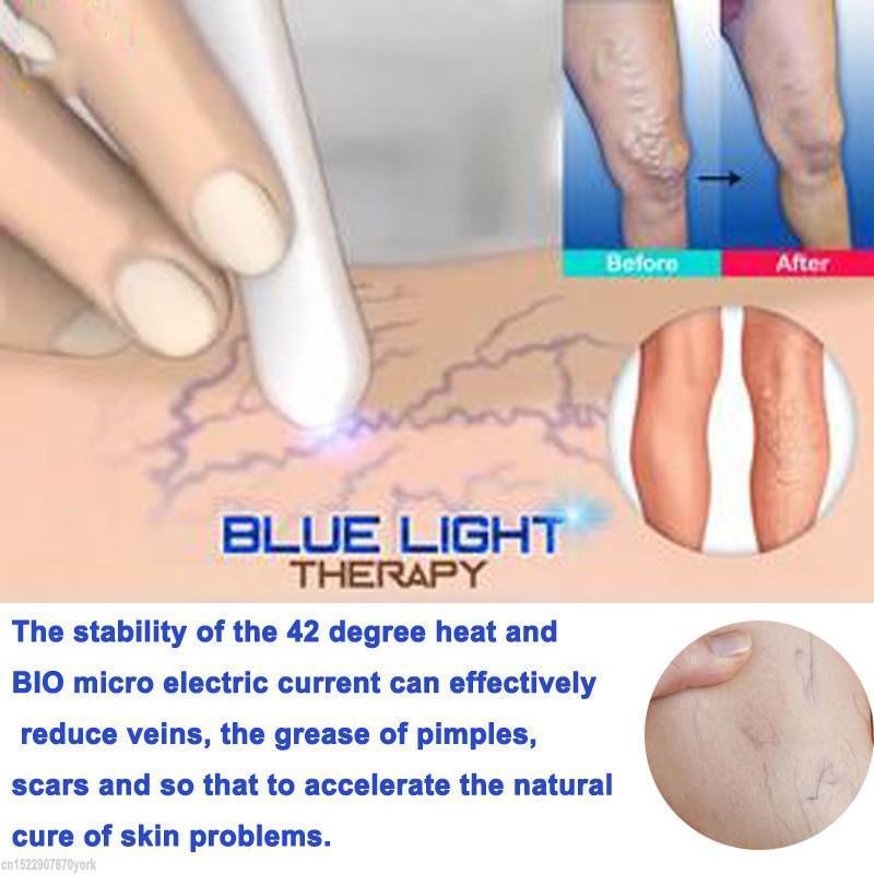 Spider Veins Removal Pen - Blue Light Therapy Laser Pen For Varicose Veins