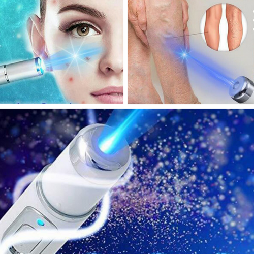 Spider Veins Removal Pen - Blue Light Therapy Laser Pen For Varicose Veins