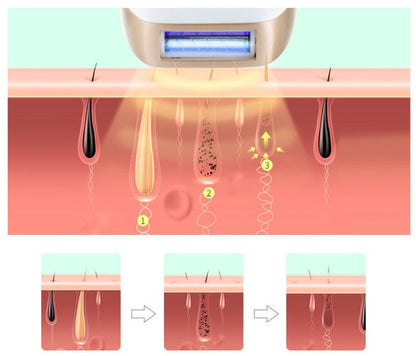 IPL Laser Hair Removal Device