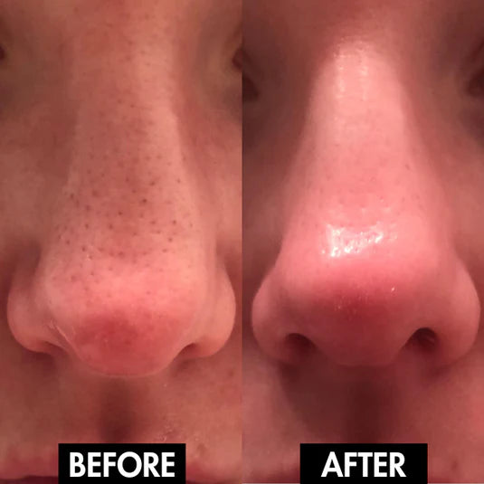 Electric Blackhead Remover Vacuum – Pore Cleaner & Acne Extractor Tool